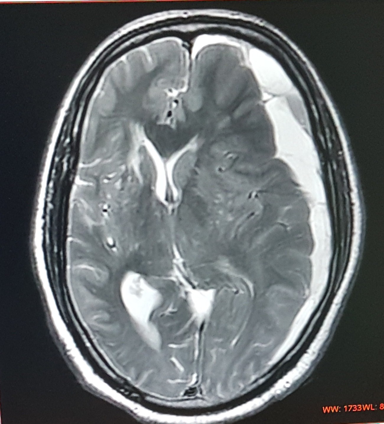 MRI BEFORE OPERATION / GPN / 12.12.17
