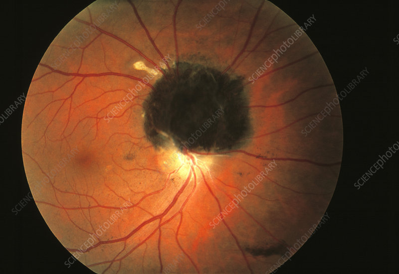 ^BBenign eye tumour.^b Ophthalmoscope view of a ^Imelanocytoma^i (dark mass), a benign tumour, on the retina, the light-sensitive membrane at the back of the eyeball. The melanocytoma has grown over part of the optic disc (pale, centre), which marks the point at which the optic nerve and retinal blood vessels enter the eye. Although the tumour is benign (non-cancerous), its growth may damage the optic nerve, leading to defective vision.