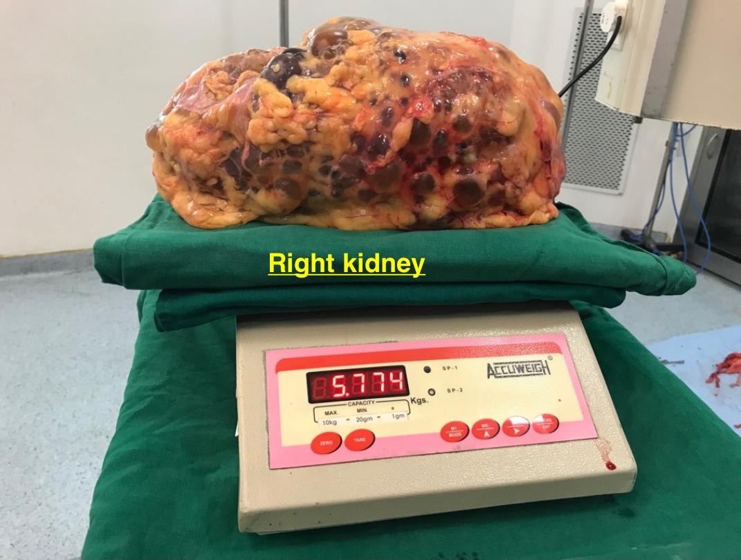Gaint Left Kideny 5.8kg