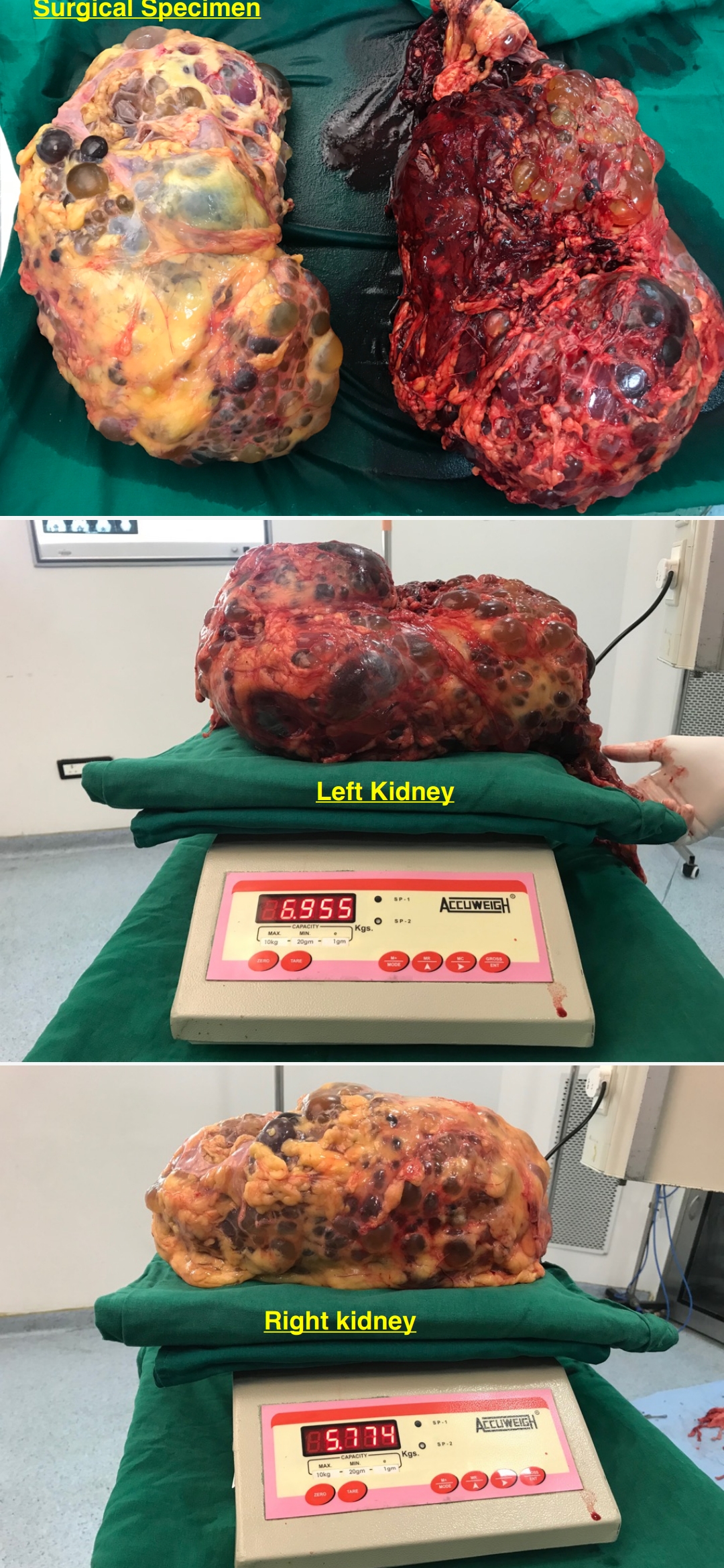 gaint kidney2
